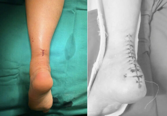 MegaDerm Trong Tăng Cường Gân Achilles – Giải Pháp Hỗ Trợ Điều Trị Tổn Thương Gân Phức Tạp