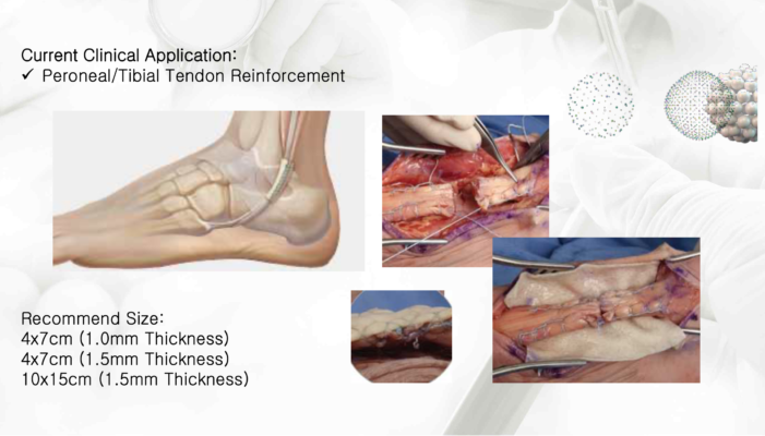 MegaDerm Trong Tăng Cường Gân Achilles – Giải Pháp Hỗ Trợ Điều Trị Tổn Thương Gân Phức Tạp