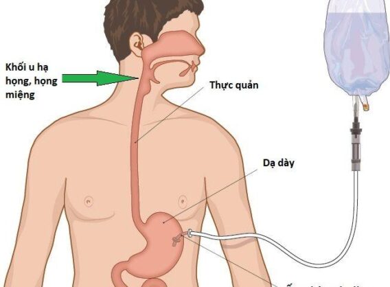 Ống thông dạ dày Nigata là gì?