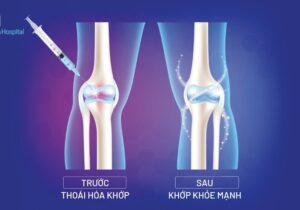 Viêm xương khớp gối và những ảnh hưởng đến chất lượng cuộc sống