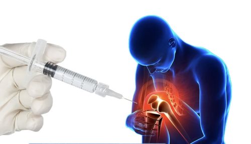 Dịch nhờn khớp gối Acid Hyaluronic tiêm nội khớp thế hệ mới