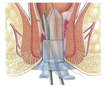 Quy trình thực hiện phẫu thuật cắt trĩ bằng máy cắt trĩ Longo Surkon chi tiết